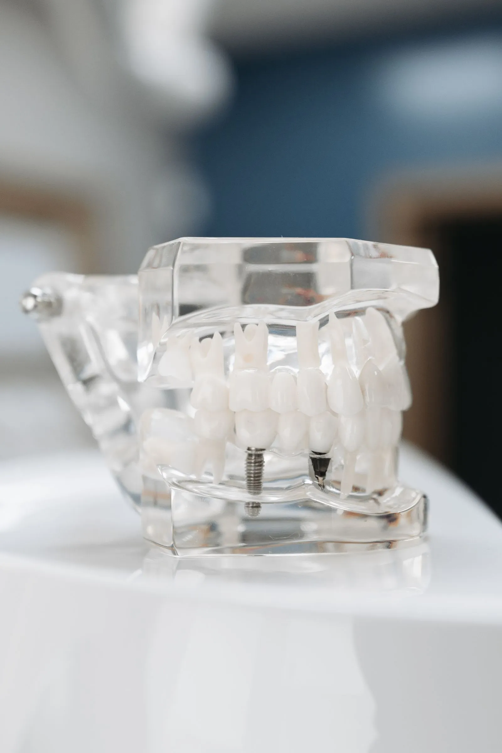 Modelo dental transparente que muestra un implante de titanio entre las piezas